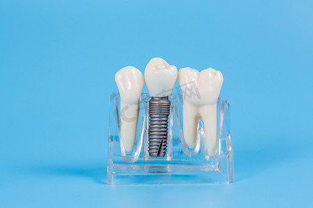 外科摄影照片_牙冠，仿制带植入物的牙桥假牙