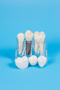 牙冠，仿制带植入物的牙桥假牙