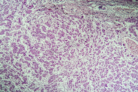 100x 显微镜下的肝癌病变组织