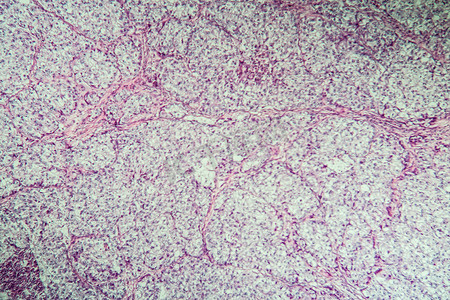 100x 显微镜下卵巢病变组织的癌症