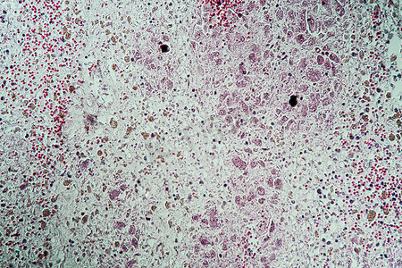 肝病变摄影照片_块茎叶蘑菇中毒后的病变肝组织