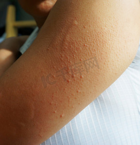 皮肤斑点摄影照片_手臂皮肤过敏性皮疹皮炎