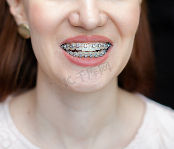 笑容牙齿摄影照片_洁白的牙齿上带着牙套的年轻女孩的笑容。