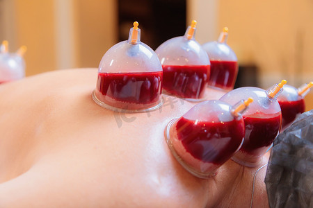 威士忌杯子摄影照片_hijama 师傅为一名年轻女孩进行真空吸血手术。