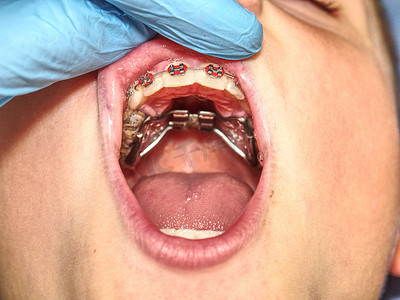 在检查或治疗期间戴牙套的患者