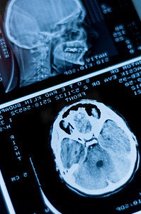 CT 扫描的特写镜头，上面有大脑和头骨