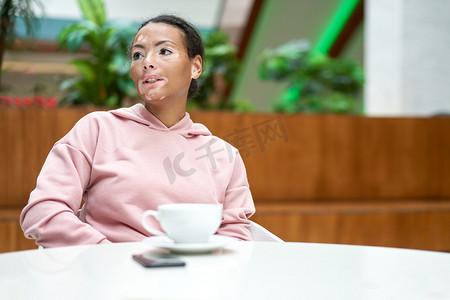 皮肤斑点摄影照片_有白斑色素沉着皮肤问题的黑人非洲裔美国女性室内穿着粉红色连帽衫