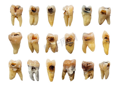 牙齿蛀牙摄影照片_一套有龋齿（蛀牙）、氟中毒和牙结石的牙齿。