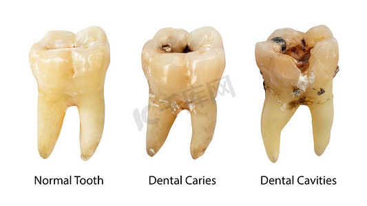 正常牙齿、龋齿和有结石的牙腔。