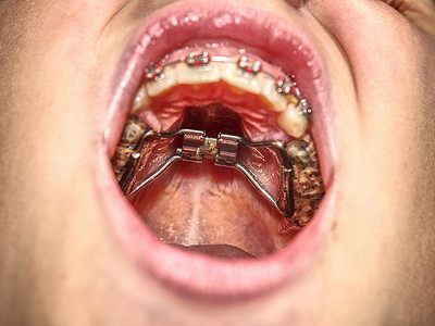 牙齿上戴着牙套的青少年。