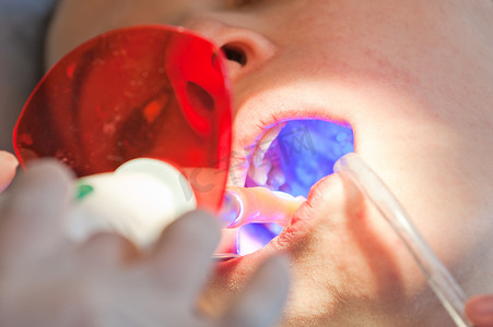 Dentinst 使用紫外线为患者制作复合牙齿填充物