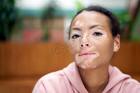 皮肤斑点摄影照片_有白斑色素沉着皮肤问题的黑人非洲裔美国女性室内穿着粉红色连帽衫