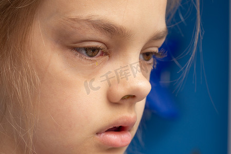 眼睛炎症摄影照片_不适的孩子，在眼睛的结膜炎