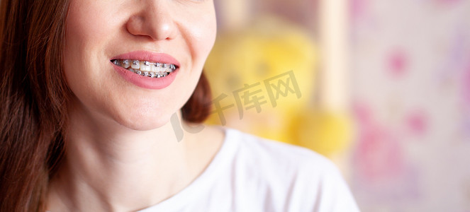 笑容牙齿摄影照片_洁白的牙齿上带着牙套的年轻女孩的笑容。