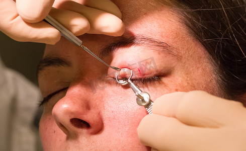 医疗保健概念-眼科检查和手术期间的霰粒肿