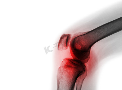 影片 x 射线膝关节与关节炎（痛风、类风湿性关节炎、化脓性关节炎、骨关节炎膝）