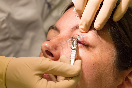 眼睛手术摄影照片_医疗保健概念-眼科检查和手术期间的霰粒肿