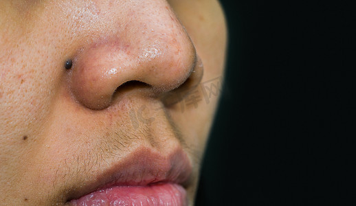 鼻子后面的黑痣需要二氧化碳激光去除。