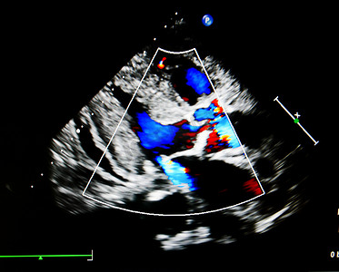 中超摄影照片_超声心动图中的血流颜色