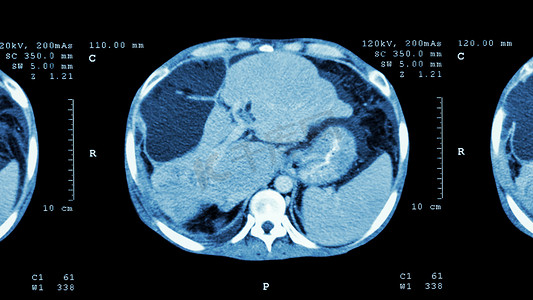上腹部CT扫描：显示肝脏异常肿块（肝癌）