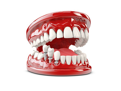 牙齿人体植入物。