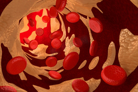 胆固醇斑块引起的动脉硬化，3D 渲染