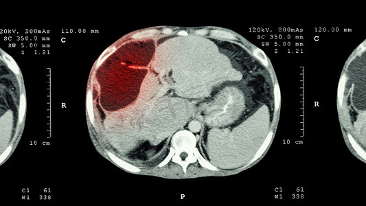 肝胆相照摄影照片_上腹部CT扫描：显示肝脏异常肿块（肝癌）