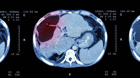 上腹部CT扫描：显示肝脏异常肿块（肝癌）