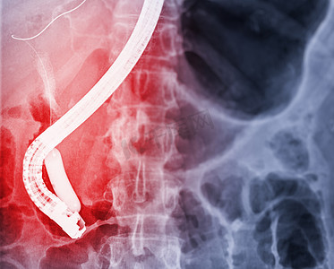 手术摄影照片_医生在现代手术室内进行 ERCP 和腹腔镜胆囊切除术后内窥镜的 X 射线图像。