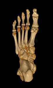足骨的 3D 渲染，用于诊断骨折和类风湿性关节炎。