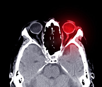 矢摄影照片_脑矢状面 CT 扫描用于诊断脑肿瘤、中风疾病和血管疾病。