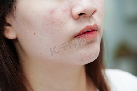 元气少女壁纸摄影照片_皮肤脸上的痤疮粉刺和疤痕、皮脂腺疾病、少女护肤美容问题。