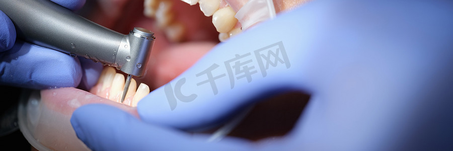牙医准备女性牙齿，以便使用钻头安装陶瓷贴面和牙冠