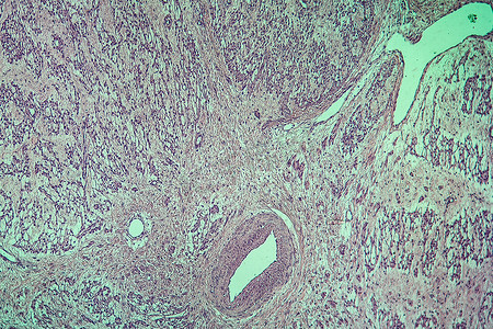 子宫肌瘤摄影照片_子宫纤维肌瘤病变组织 100x