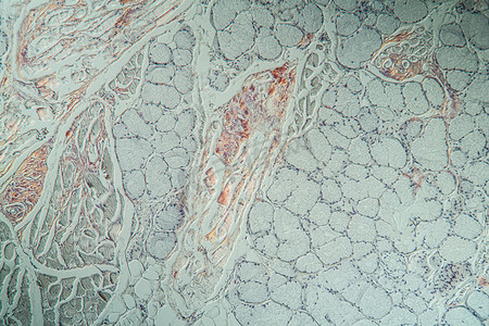 显微镜下舌头上有病组织的淀粉样沉积物