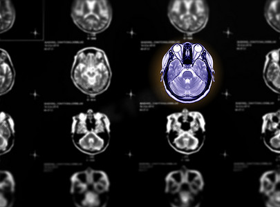 MRI 脑轴视图的选择性焦点用于检测脑中风疾病的各种状况。