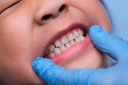 一个健康儿童口腔内的特写镜头，其乳牙一排排漂亮。