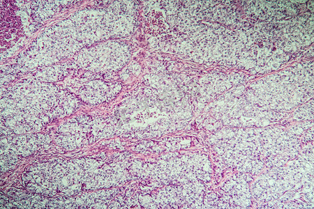 卵巢癌摄影照片_100x 显微镜下卵巢病变组织的癌症