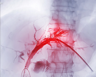 胰腺炎摄影照片_医生在现代手术室内进行 ERCP 和腹腔镜胆囊切除术后门静脉的 X 射线图像。