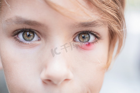 儿童眼睛麦粒肿的特写。