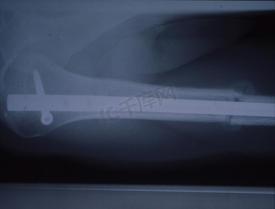 事故后钉骨的 X 光检查