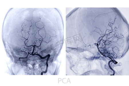 介入放射学透视中的脑血管造影图像显示脑动脉。