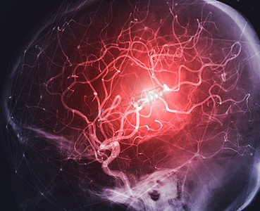 介入放射学透视中的脑血管造影图像显示脑动脉。