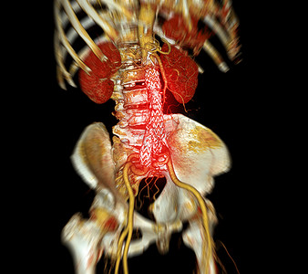 全主动脉 CTA 与腹主动脉支架移植物比较 3D 渲染图像。