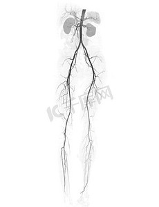 CTA 股动脉走线显示股动脉，用于诊断急性或慢性外周动脉疾病。
