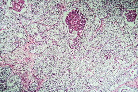 100x 显微镜下卵巢病变组织的癌症