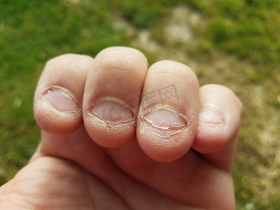 被咬过的讨厌的不健康的粗糙的咀嚼指甲的坏习惯