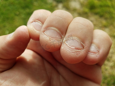 咬指甲摄影照片_被咬过的讨厌的不健康的粗糙的咀嚼指甲的坏习惯
