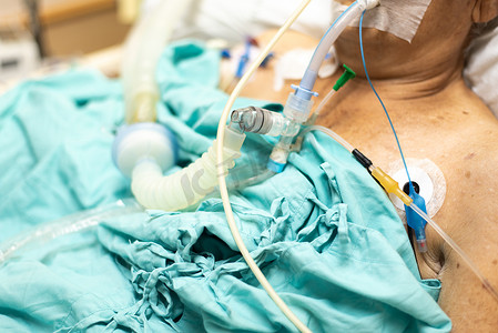 病人在医院做气管切开术和呼吸机