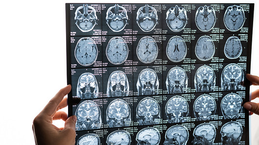 一位女医生正在检查大脑的核磁共振扫描。